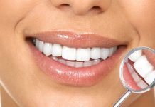 Estetinis plombavimas – priežastys, kodėl verta jį rinktis estetinis plombavimas